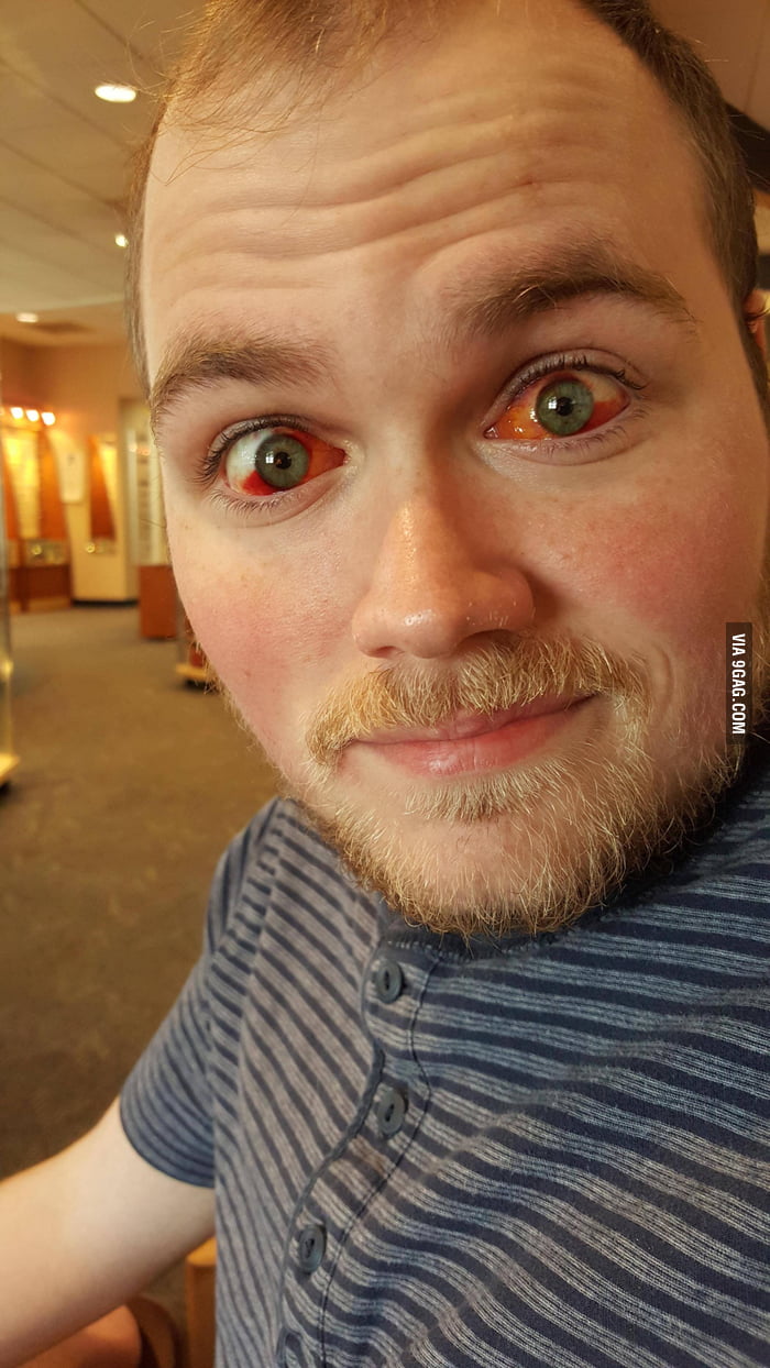 This guy just had lazy eye correction surgery. Uh, at least his eyes are - aApw32d_700b