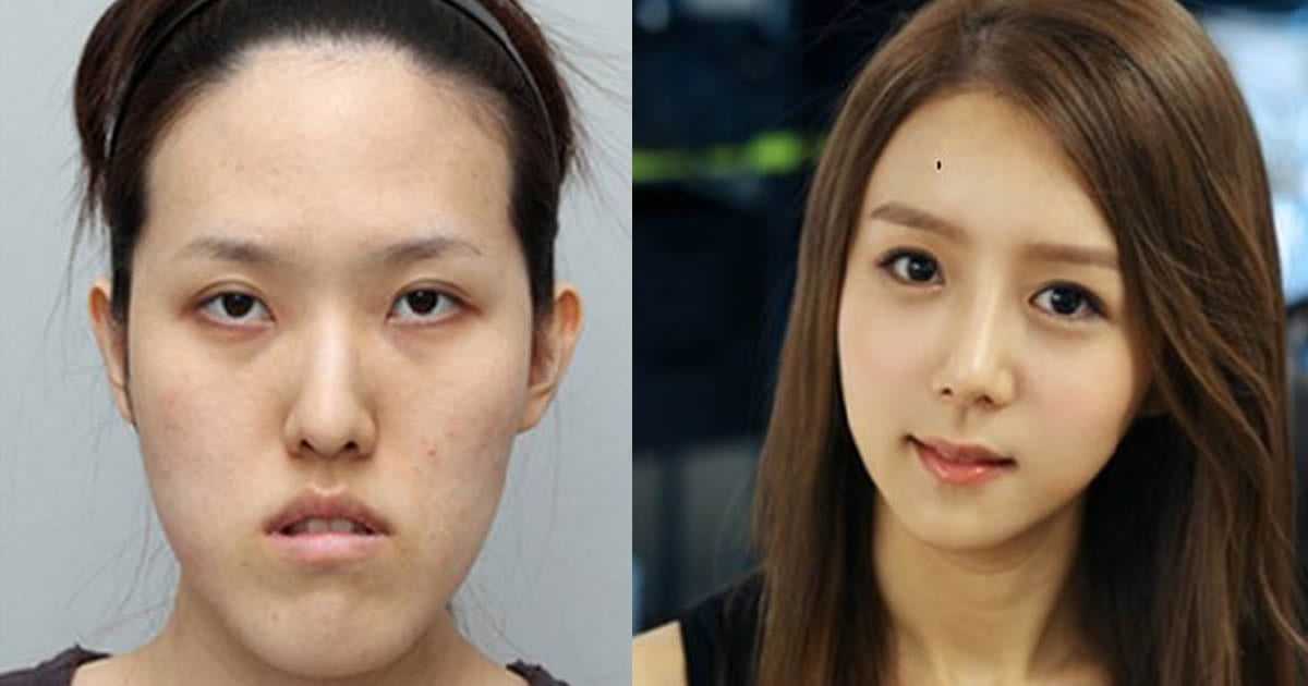 19 Before And After Photos From Korean Plastic Surgery Makeover Show - Girl...