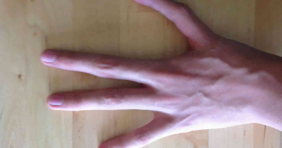 Man born without thumb had index surgically removed at birth to replace ...