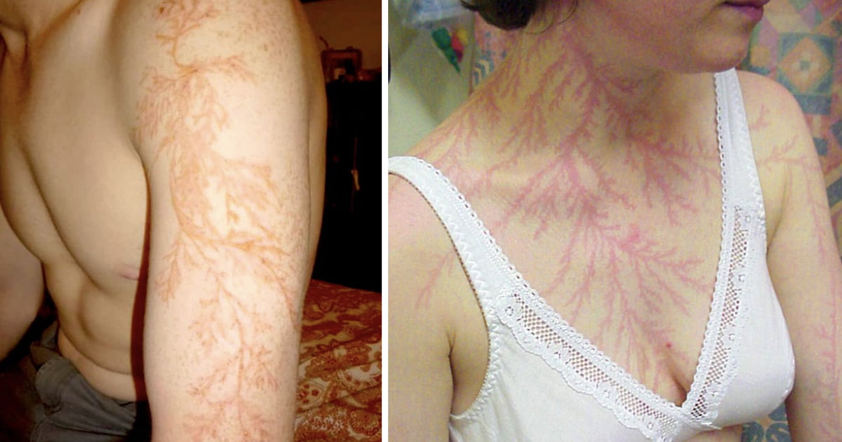 People Who Survived Getting Struck By Lightning Show What It Does To 