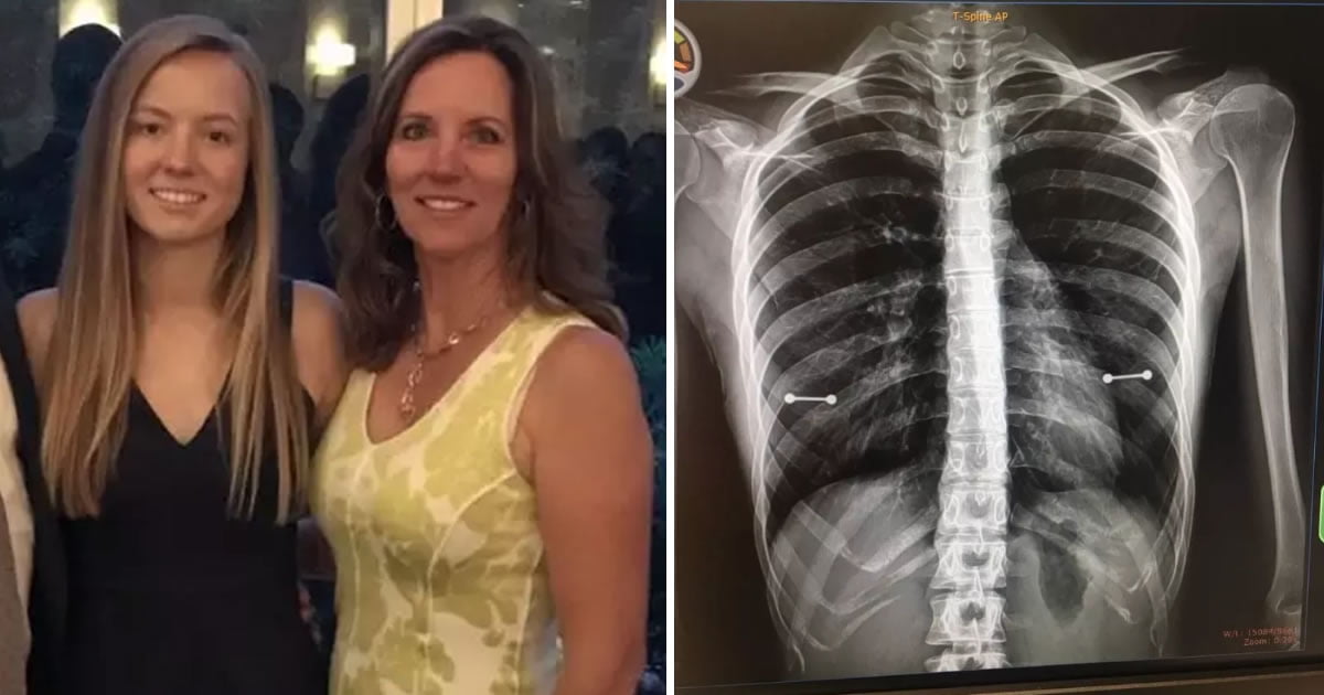 Mum Accidentally Finds Out Daughter Has Nipple Piercings After XRay 9GAG