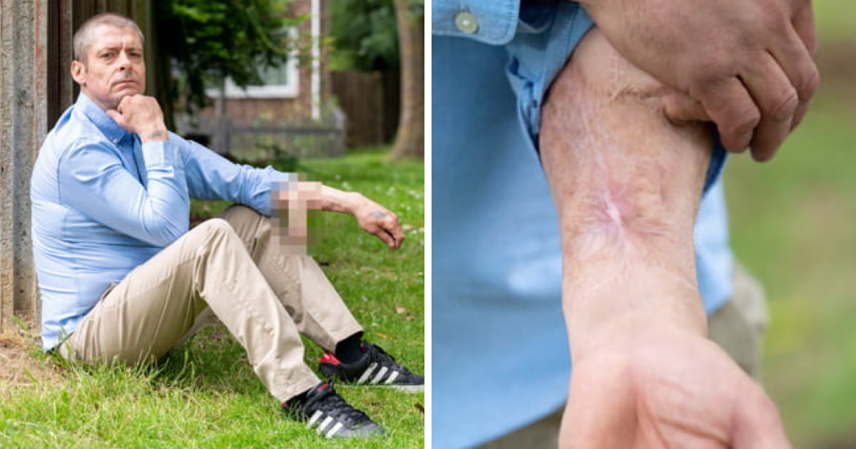 This Man Who Lost Penis Now Has A New One Grown From His Arm 9GAG