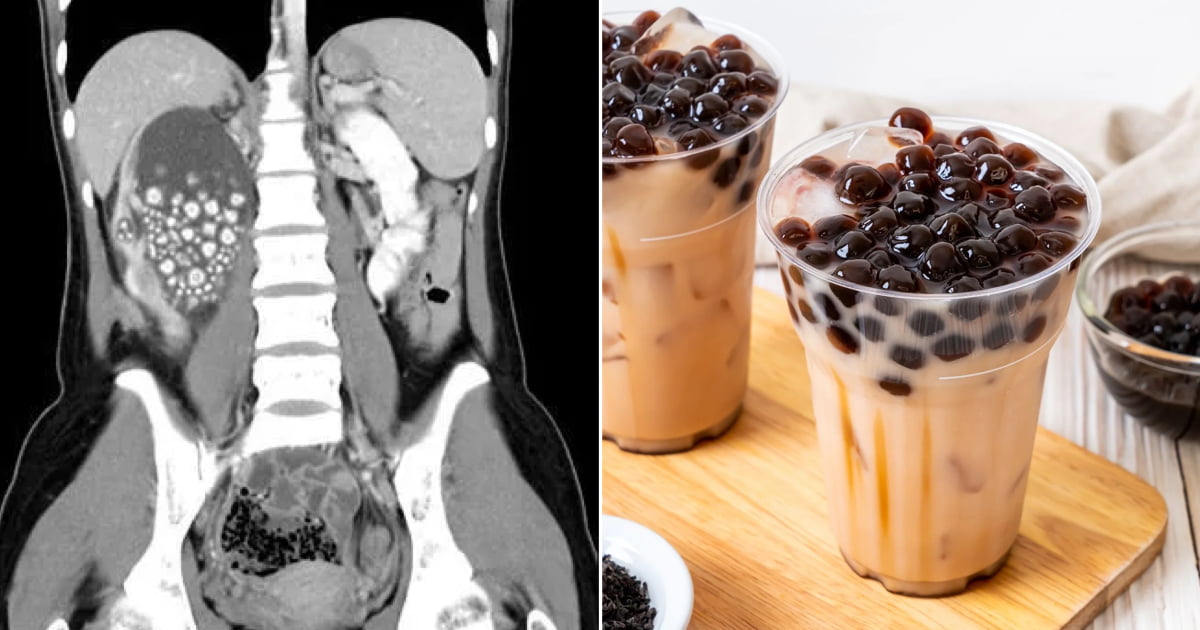 Doctors Remove Over 300 Kidney Stones From Woman Who Prefers Bubble Tea To Plain Water 9GAG