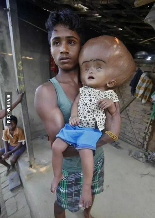A kid with hydrocephalus from India. 9GAG