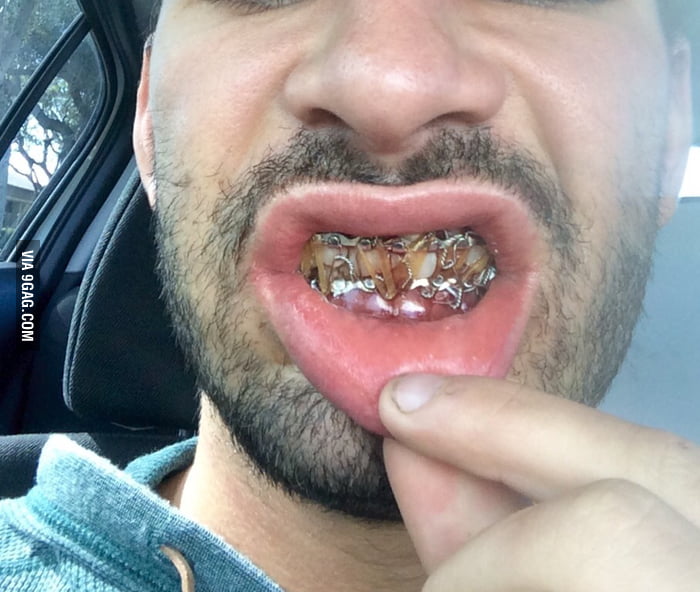 This Is What It Looks Like To Have Your Jaw Wired Shut 9GAG