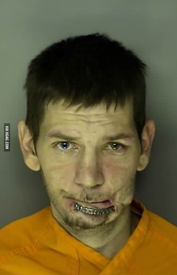 A Mandibular Reconstruction Bar Eroded In A Mugshot 9GAG   A0proKQ 700b 