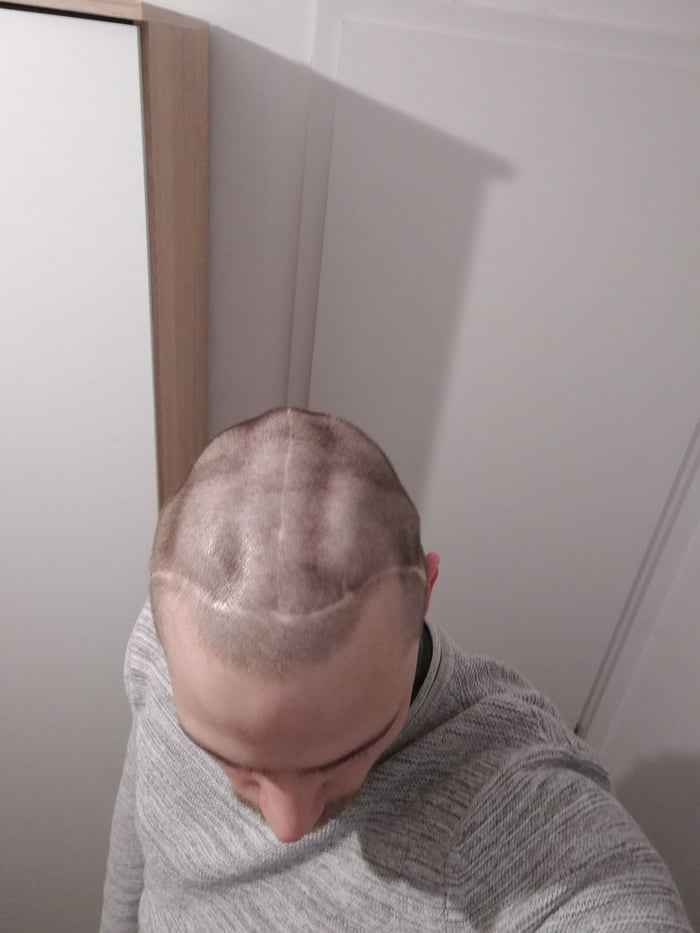 I Had A Surgery On My Head When I Was 9 Months Old It s The First Time That I See My Scar I m 