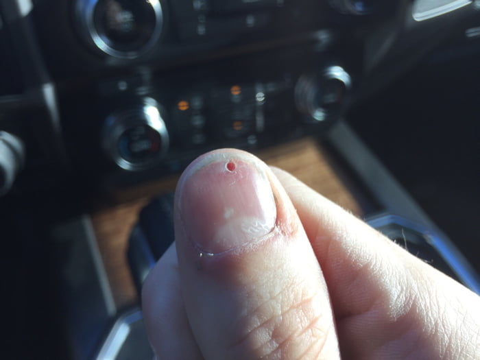 i-read-that-drilling-a-hole-in-an-injured-finger-nail-can-release