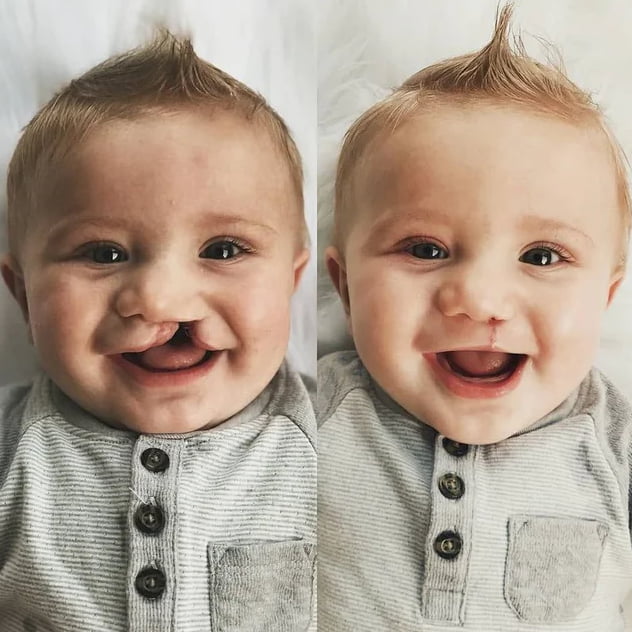 Cleft lip and cleft palate, two week surgery - 9GAG