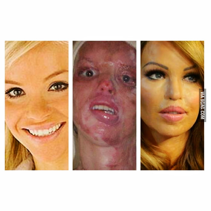 Acid Attack Katie Piper Before And After