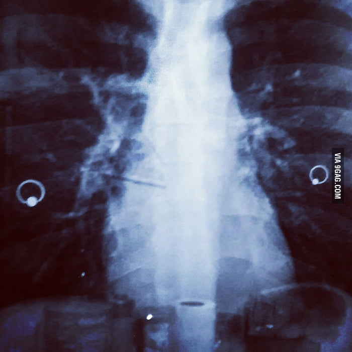 So, I had an xray done... and I have nipple piercings... 9GAG