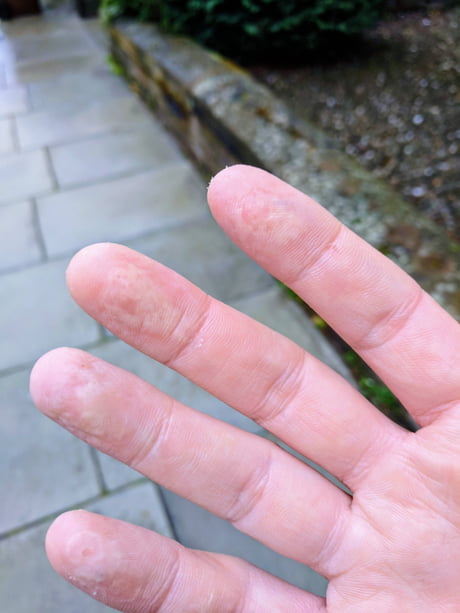 After A Day Of Cleaning With Bleach And No Gloves My After A Day Of Cleaning With Bleach And No Gloves My