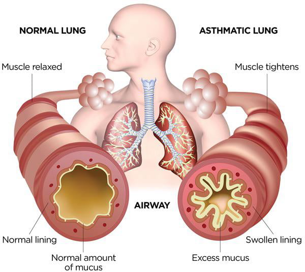 Normal lung vrs asthmatic lung - 9GAG