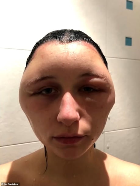 Woman S Head Puffed Up After Allergic Reaction To Hair Dye 9gag