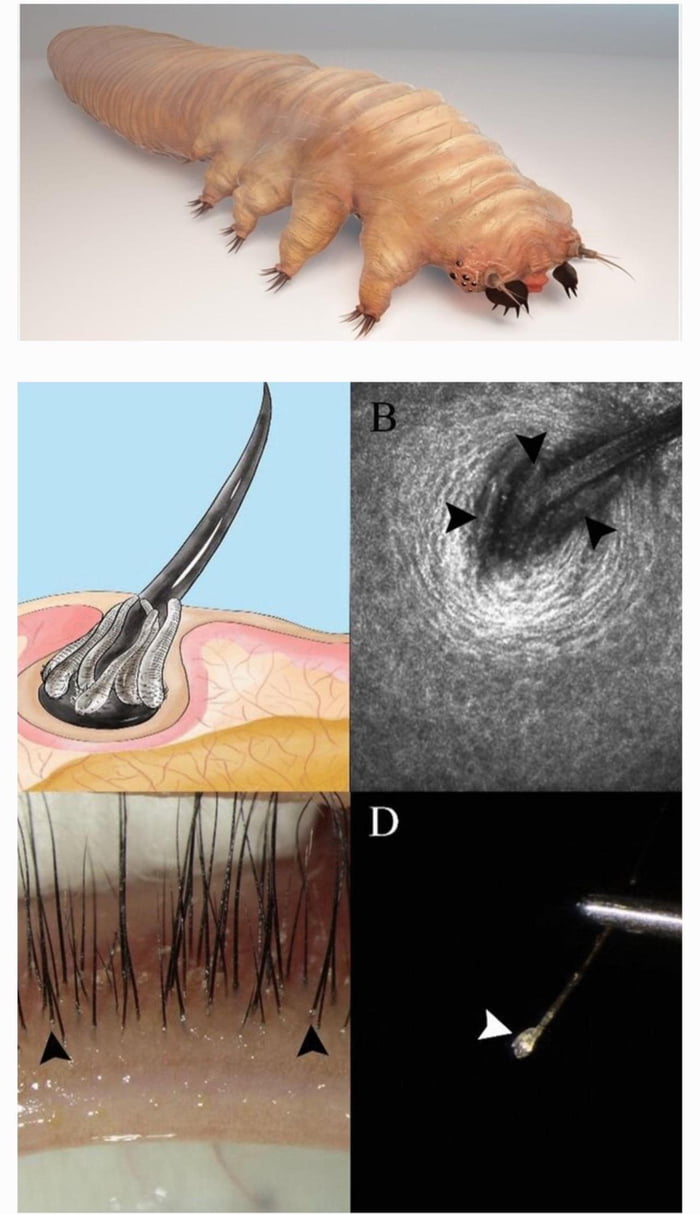 Demodex mites - they burrow into your eyelash follicles in the ...