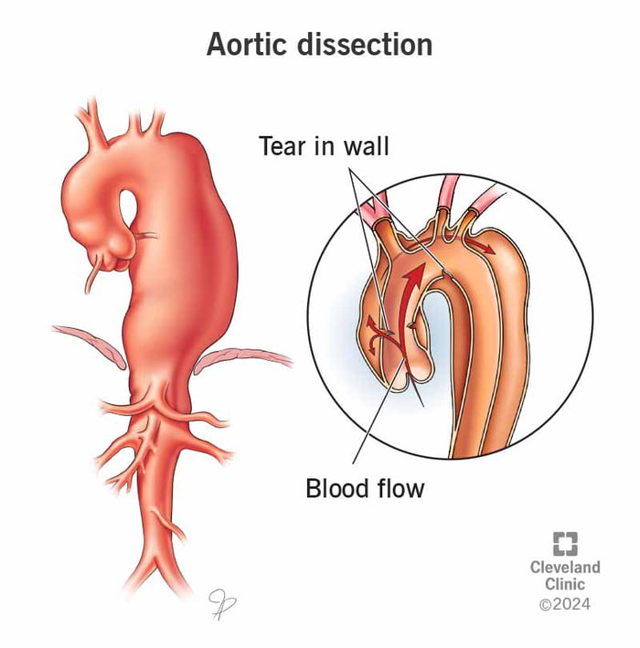 Loss my dad in just two hours due to aortic dissection/rupture, feeling ...