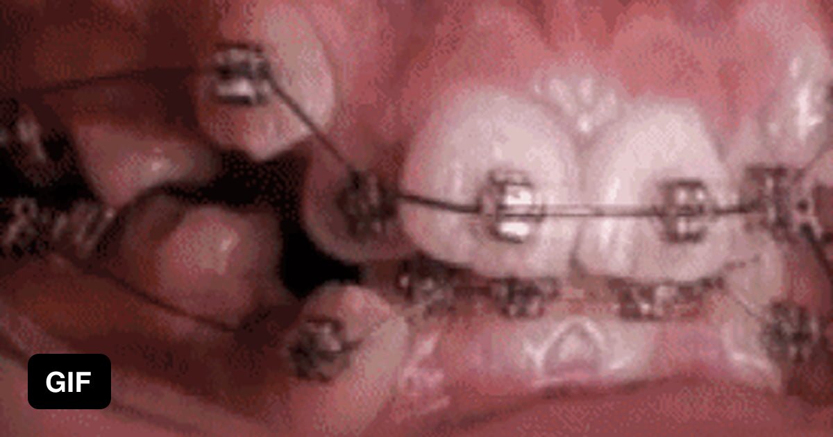 A time lapse of braces straightening teeth 9GAG