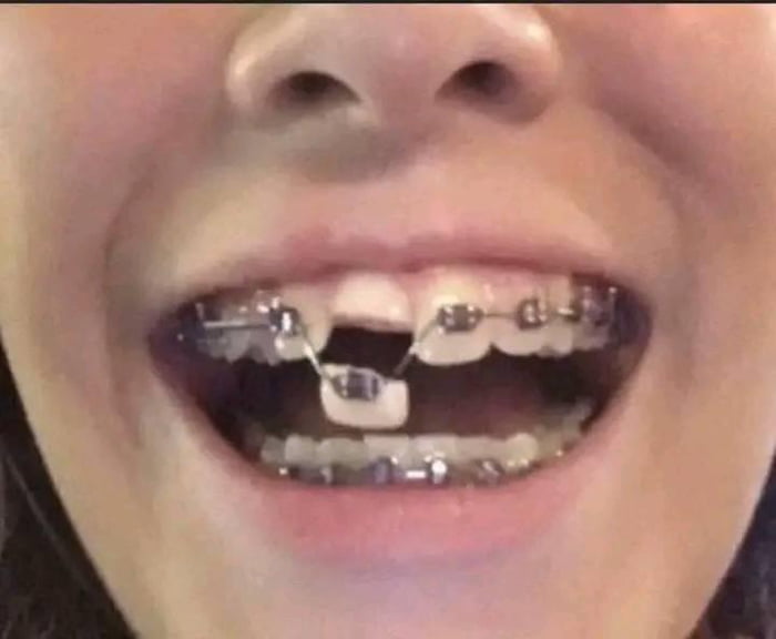 He’s gonna need more than just braces to fix that 9GAG