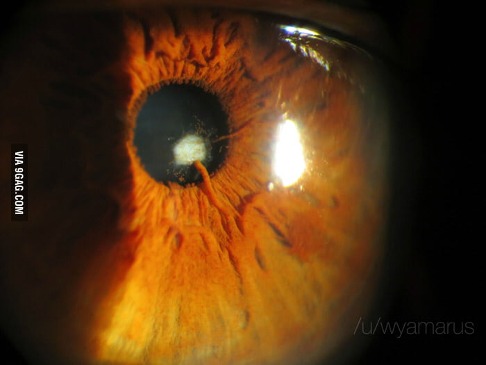 Iris growing into the pupil. 9GAG