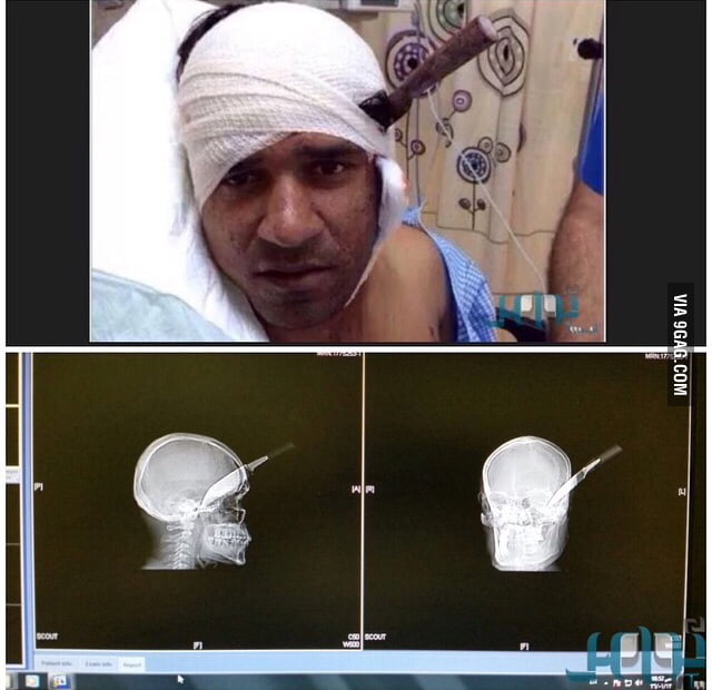 Man survives knife to the head ! 9GAG