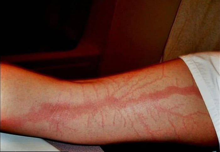 This is what it looks like when you get struck by lightning. The extremely  high temperature causes burning and scarring which leaves a lightning-like  scar known as a Lichtenberg figure - 9GAG