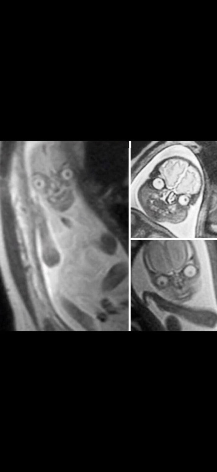 Mri Scan Of Baby In Womb