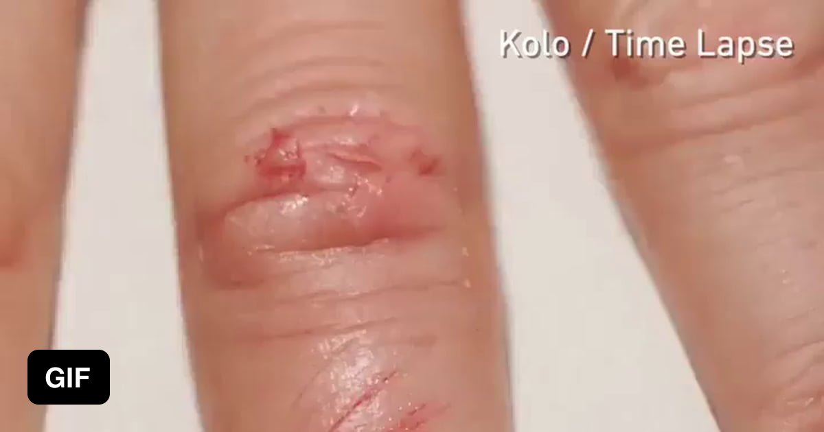 Time lapse of wound healing over 33 days 9GAG