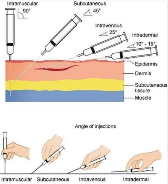 Parenteral Vs Injection at Linda Daugherty blog