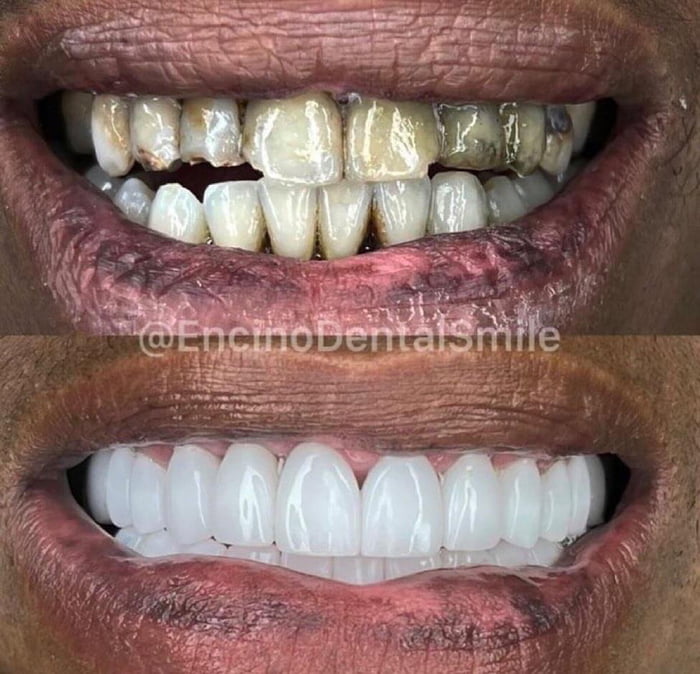 First rapper to have mold on his teeth 😎 - 9GAG