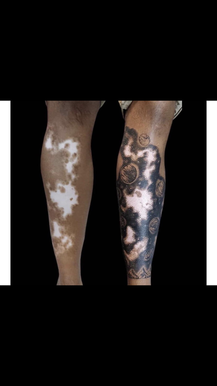 Vitiligo Camouflage Tattoo - La Klinic