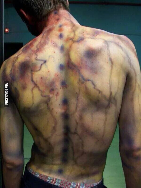 Bruising from lightning strike - awesome! - 9GAG