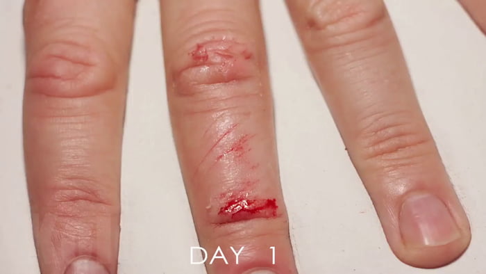 Wound Healing TimeLapse - 9GAG