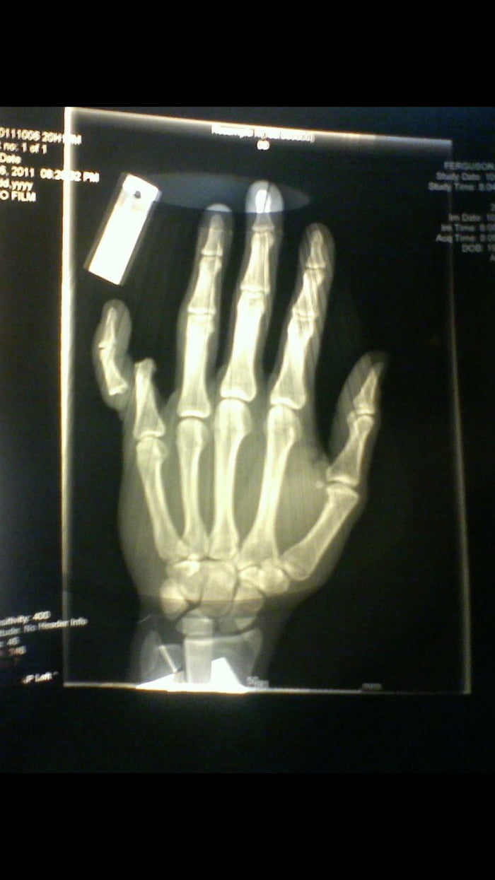 the-x-ray-of-my-left-pinky-finger-after-an-open-dislocation-injury-9gag