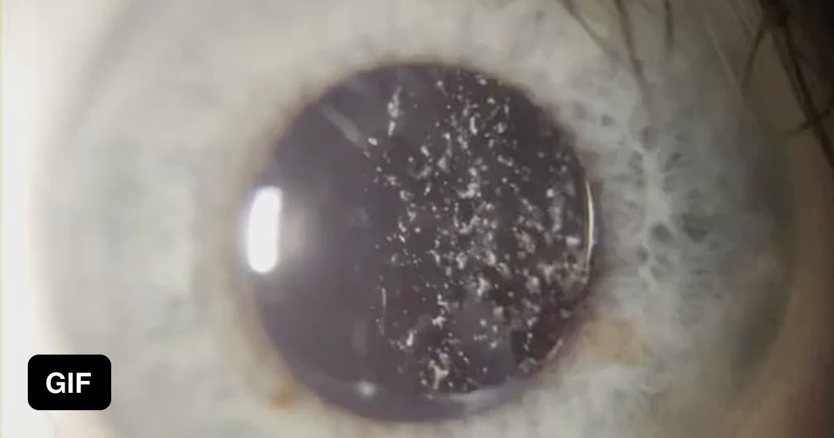 Snow globe eye. Asteroid hyalosis is a condition where people have