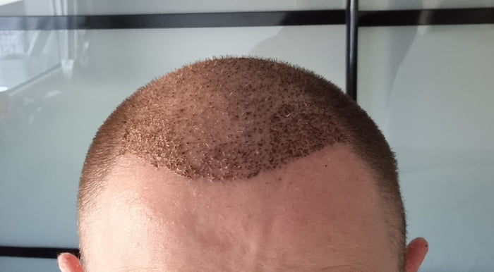 Remember Guys There Re No Ugly People In The World Just Poor People D Got Myself An Old Hairline Did It In Istanbul Paid 20 3500 Grafts Dhi Technique 9gag