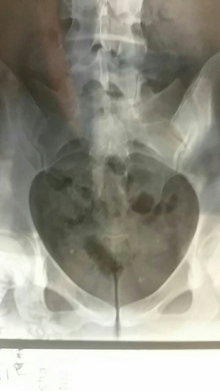 Embarrasing X Rays This is embarrassing. I'm waiting the doctor, decided to look at my x ...