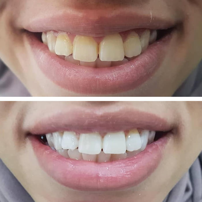 Results after three weeks of switching toothpaste & teeth whitening. - 9GAG