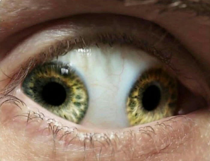 Изменить расположение зрачка фото Pupula duplex. An extremely rare condition where there are two pupils in one eye