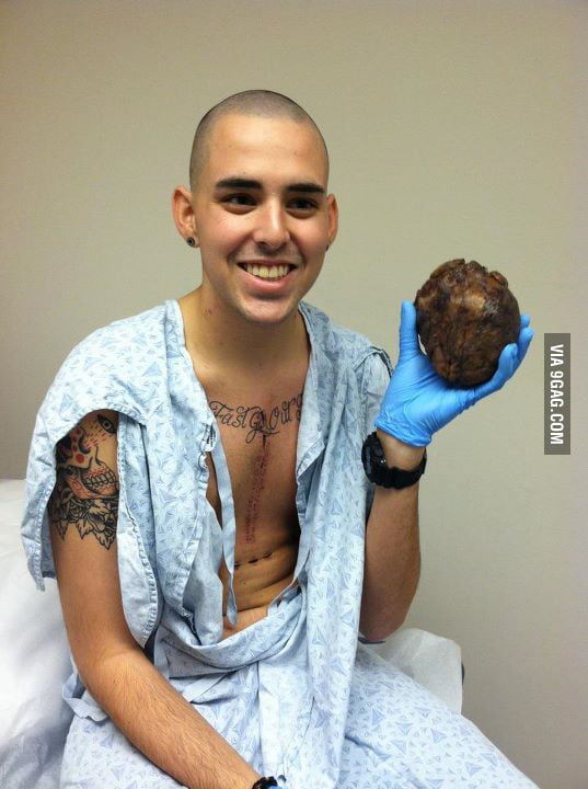 Как на самом деле выглядит сердце Man holds his own old diseased heart after transplant - 9GAG