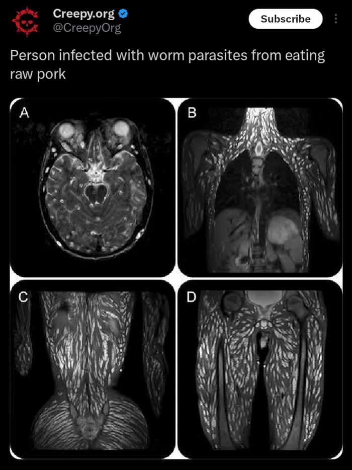 Person infected with worm parasites from eating raw pork - 9GAG