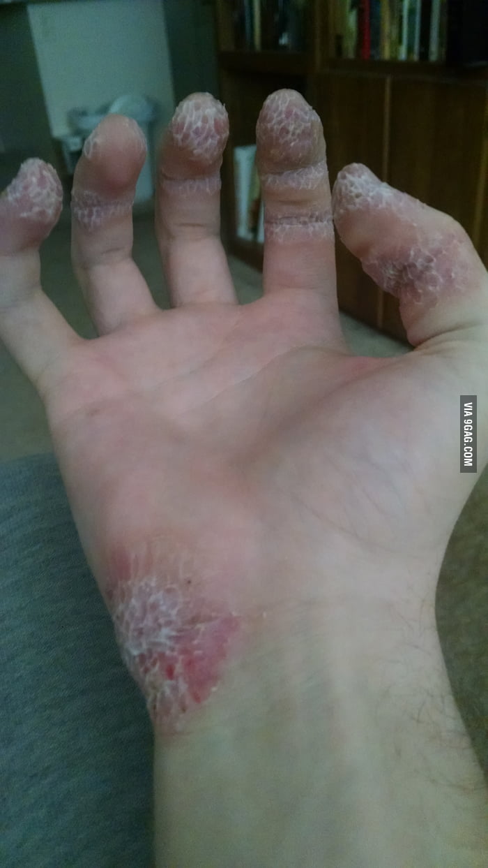 I have Dermatophagia. Here's what my right hand looks like after ...