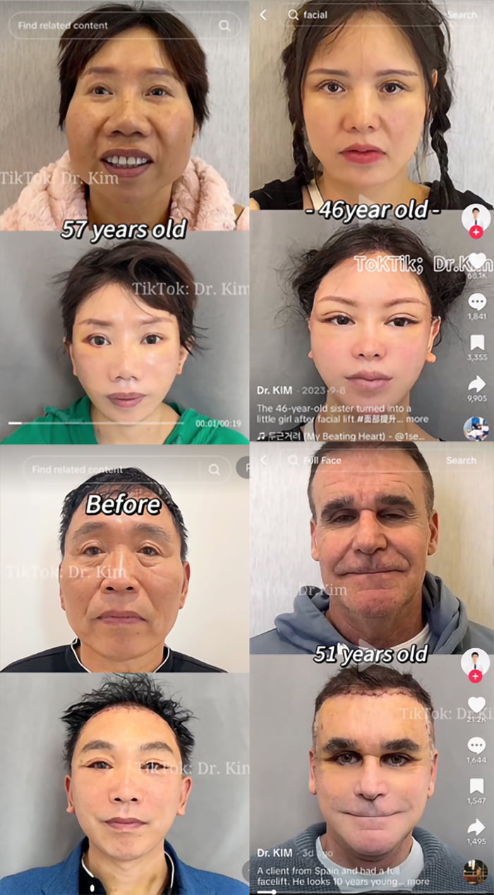 before-and-after-face-lift-surgery-by-dr-kim-9gag