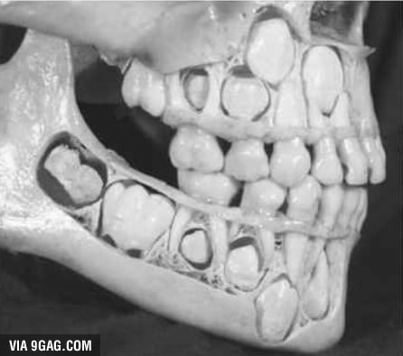 A child's skull before the milk teeth fall out - 9GAG