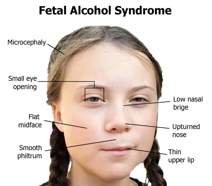 Alcohol symptoms syndrome fetal of Fetal alcohol