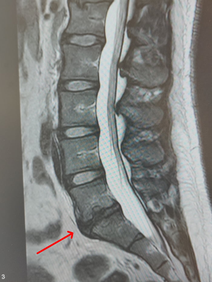 I vahe a degenerative disk which is causing me pain since almost a year ...