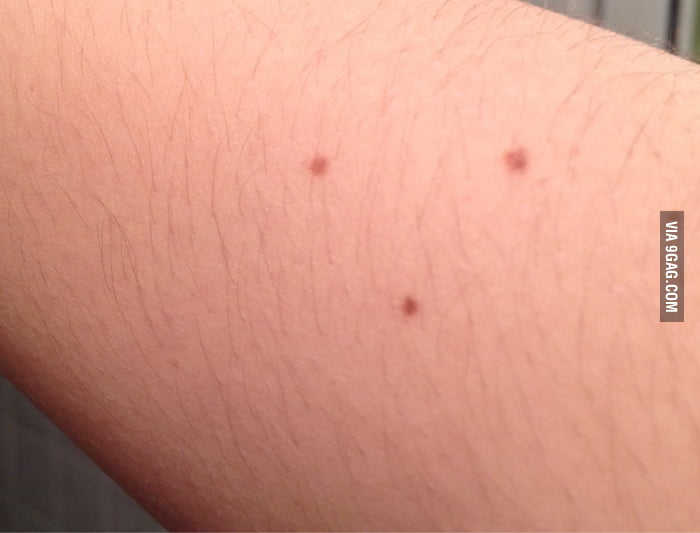 New mole on arm makes a triangle. Guess I'm illuminati now. - 9GAG