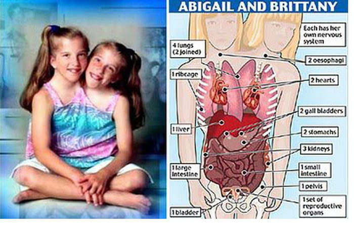 The anatomy of conjoined twins, Brittany and Abbey. - 9GAG