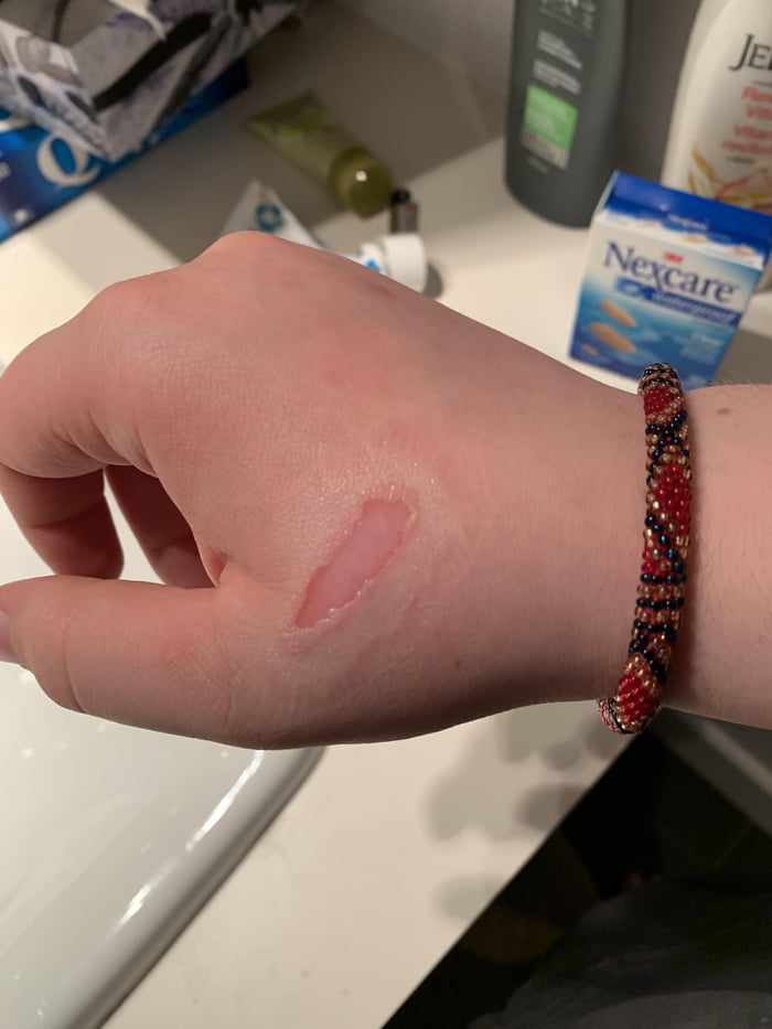 Burned myself in the oven… 9GAG