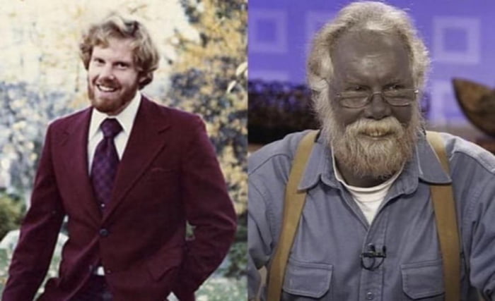This Man Skin Turned Blue After Drinking Colloidal Silver For Over A This Man Skin Turned Blue After Drinking Colloidal Silver For Over A