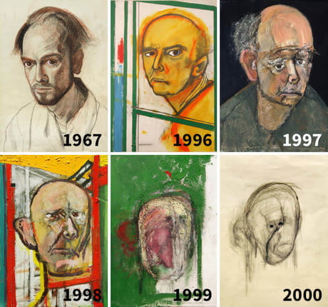 There was an artist named William Utermohlen who was diagnosed with